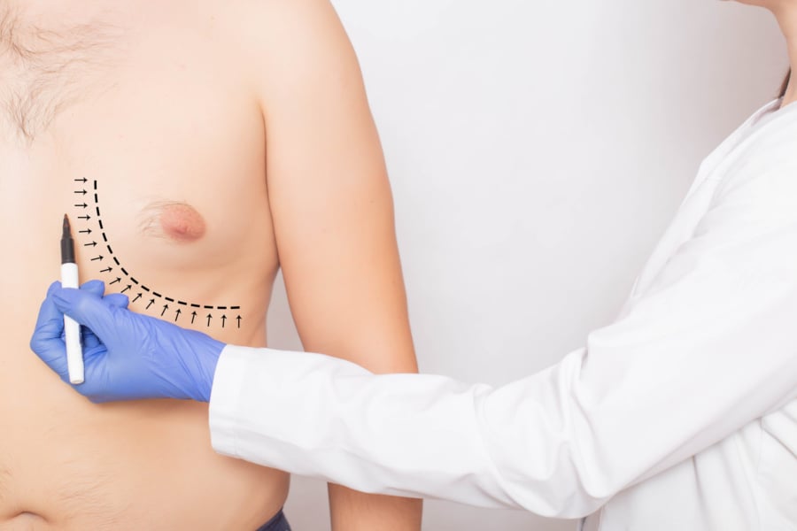 Gynecomastia in Turkey:Procedure, Before & After Results