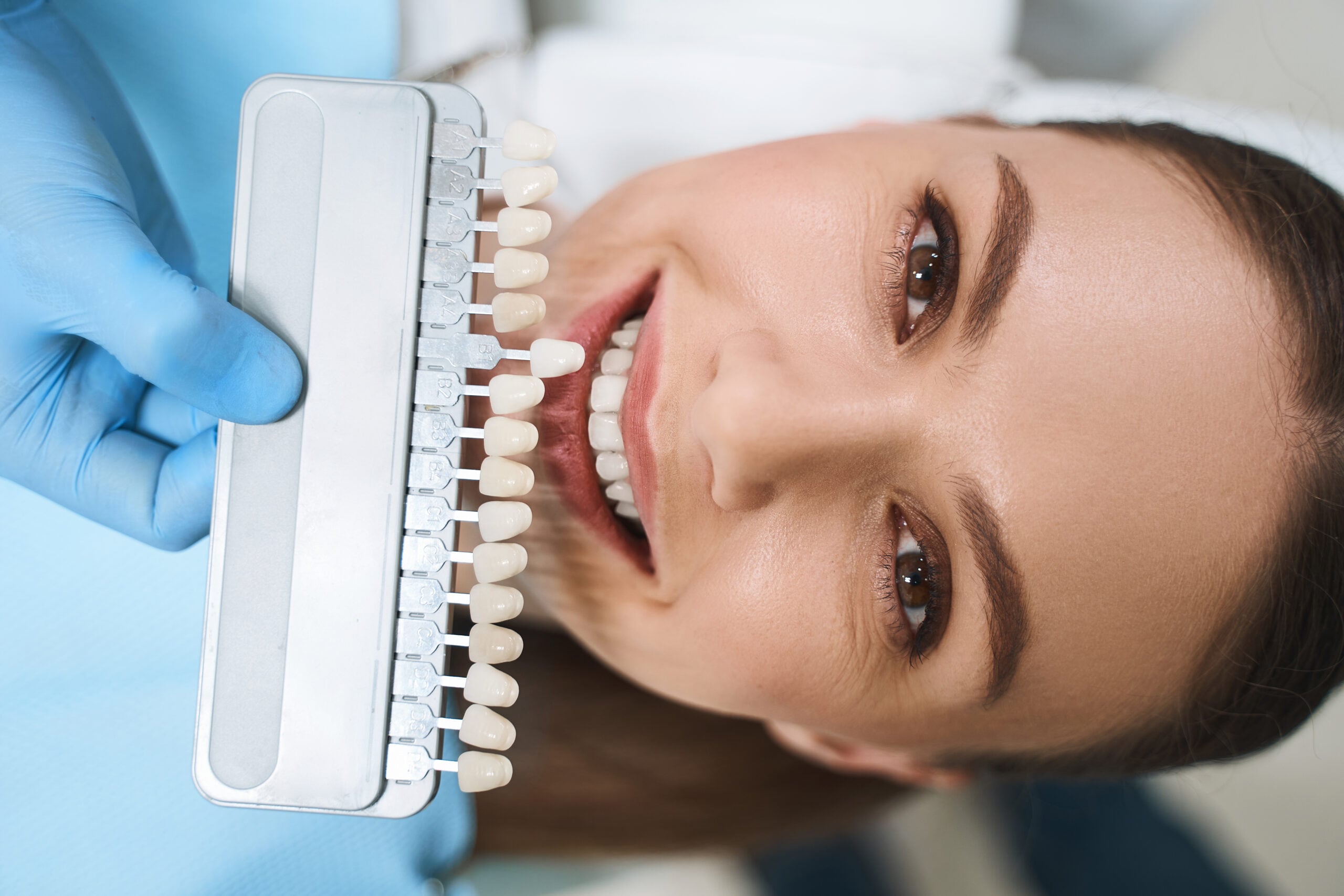 Faccette dentali in Turchia risultati prima e dopo del rifacimento del sorriso